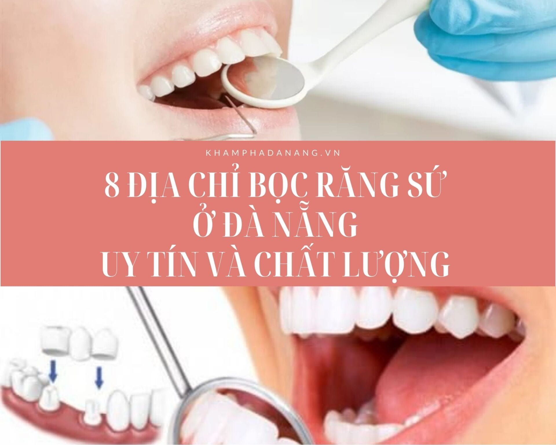 Bọc răng sứ Đà Nẵng