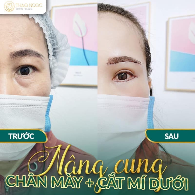 địa chỉ nhấn mí đẹp ở Đà Nẵng